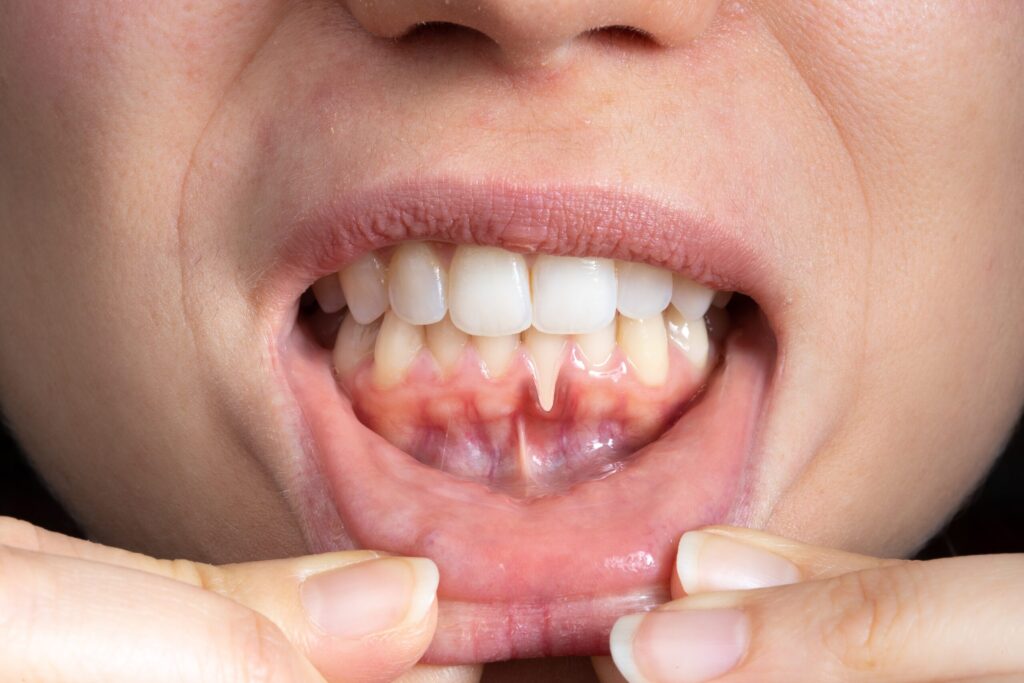 Preparing for teeth whitening with receding gums Leamington Spa